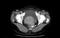 Non-puerperal uterine inversion (Radiopaedia 78343-91094 A 67).jpg