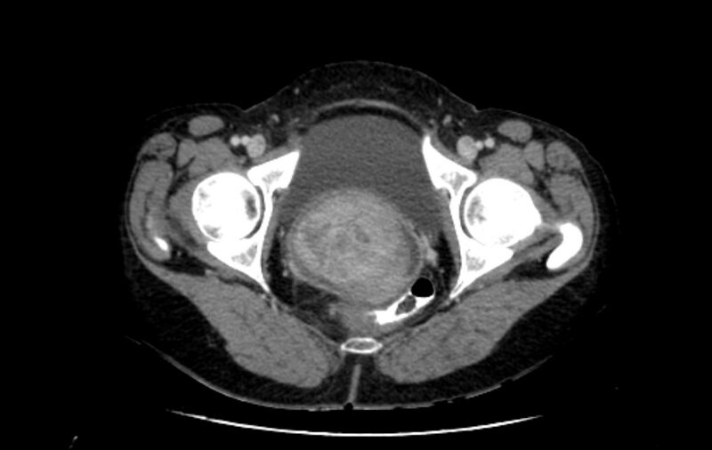 File:Non-puerperal uterine inversion (Radiopaedia 78343-91094 A 67).jpg