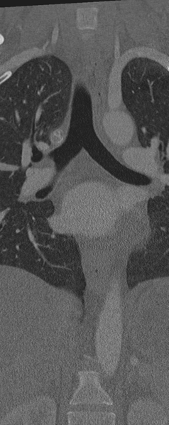 File:Normal CT thoracic spine (Radiopaedia 40181-42688 Coronal bone window 17).png
