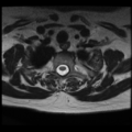 Normal cervical and thoracic spine MRI (Radiopaedia 35630-37156 Axial T2 5).png