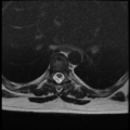 Normal cervical and thoracic spine MRI (Radiopaedia 35630-37156 H 27).png