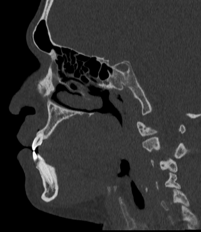 Normal facial bone CT (Radiopaedia 88742-105476 Sagittal bone window 77).jpg