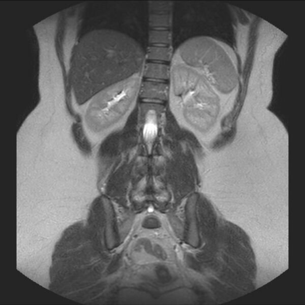 File:Normal liver MRI with Gadolinium (Radiopaedia 58913-66163 Coronal T2 30).jpg