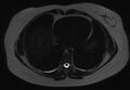 Normal liver MRI with Gadolinium (Radiopaedia 58913-66163 E 31).jpg
