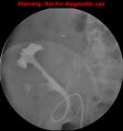 Normal retrograde pyelography of a native and transplant kidney (Radiopaedia 40480-43054 Transplant kidney 8).jpg