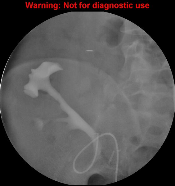 File:Normal retrograde pyelography of a native and transplant kidney (Radiopaedia 40480-43054 Transplant kidney 8).jpg