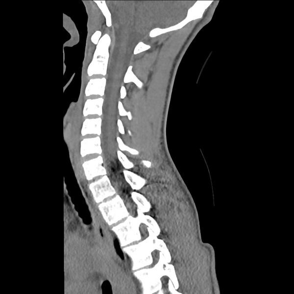 File:Normal trauma spine imaging (age 16) (Radiopaedia 45335-49358 C 22).jpg