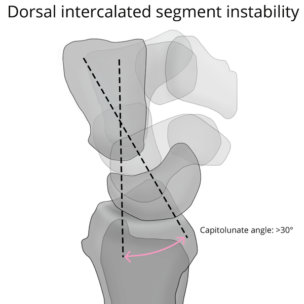 File:Normal wrist alignment, dorsal and volar intercalated segmental instability (illustration) (Radiopaedia 80949-94489 A 3).png