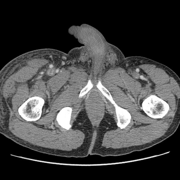 File:Obstructive bladder transitional cell carcinoma (Radiopaedia 9825-10410 A 39).jpg