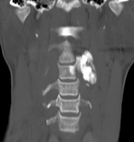 File:Osteoblastoma - cervical spine (Radiopaedia 85114-100667 Coronal 1).jpg