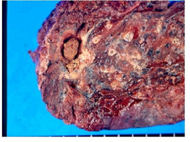 Gross view of fungus ball after left upper lobectomy