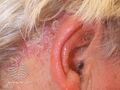 Psoriasis (DermNet NZ dermatitis-otitis6).jpg