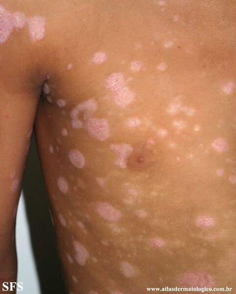 File:Psoriasis (Dermatology Atlas 85).jpg