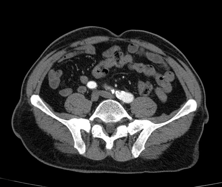File:Abdominal aortic aneurysm (Radiopaedia 22421-22458 C+ arterial phase 66).jpg