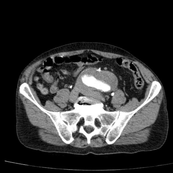 File:Abdominal aortic aneurysm (Radiopaedia 29248-29660 Axial C+ arterial phase 63).jpg