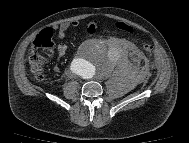 File:Abdominal aortic aneurysm rupture (Radiopaedia 54179-60362 Axial C+ arterial phase 39).jpg