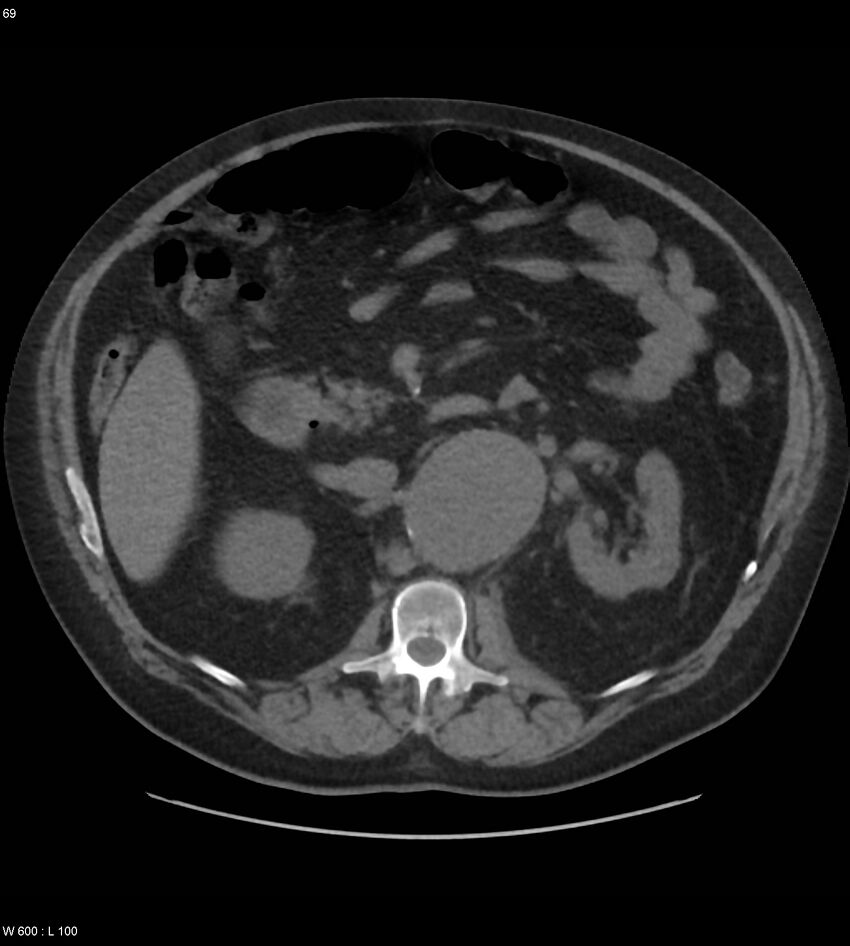 Abdominal aortic aneurysm with intramural hematoma then rupture (Radiopaedia 50278-55631 Axial non-contrast 65).jpg