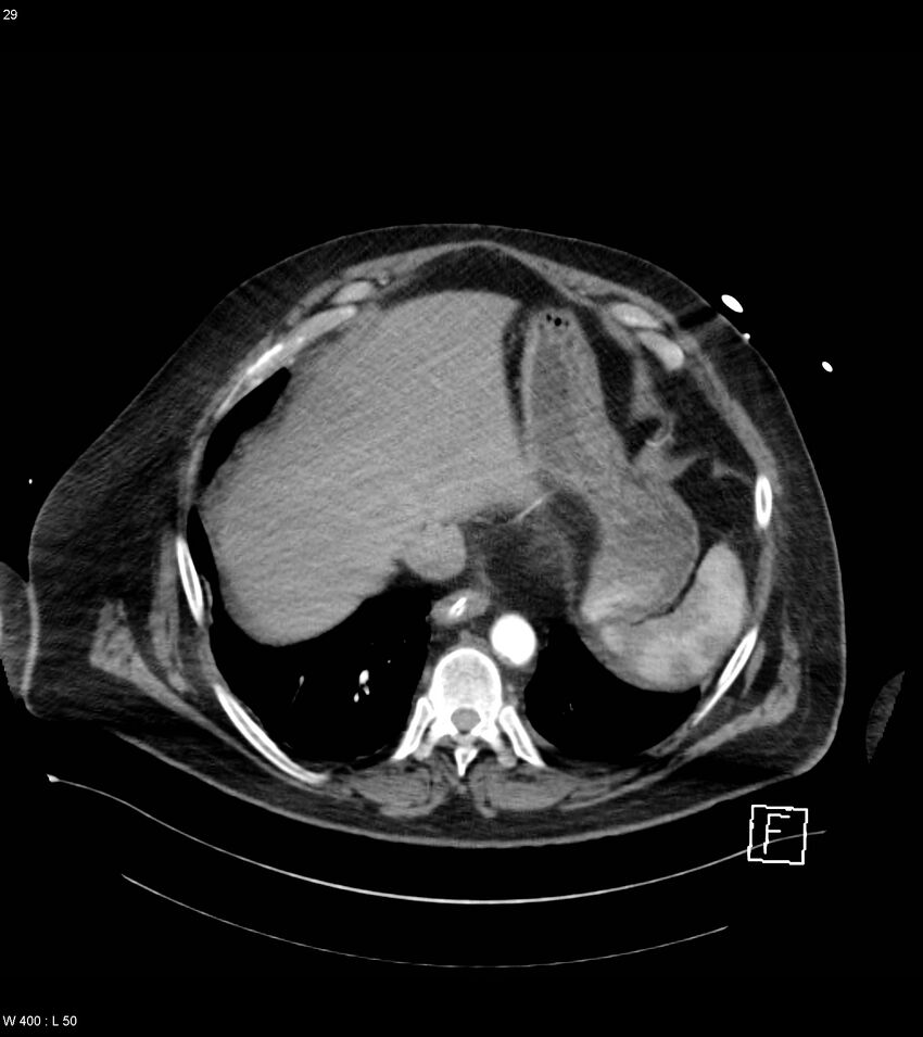 Abdominal aortic aneurysm with intramural hematoma then rupture (Radiopaedia 50278-55632 Axial C+ arterial phase 28).jpg