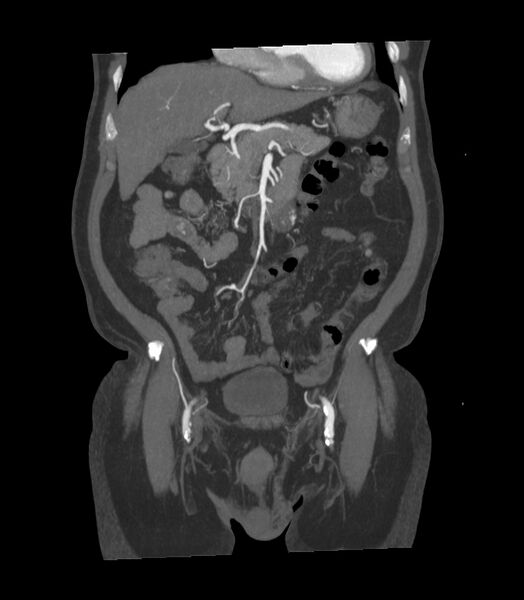 File:Abdominal aortic aneurysm with thrombus fissuration (Radiopaedia 46218-50618 Coronal C+ arterial phase 26).jpg