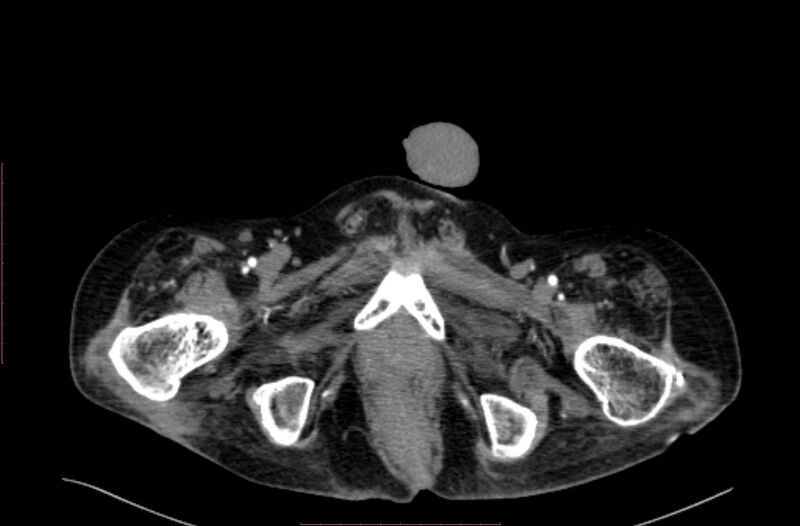 File:Abdominal aortic interposition tube graft and aneurysm thrombosis (Radiopaedia 71438-81857 Axial C+ arterial phase 260).jpg