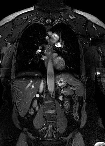 File:Aberrant right subclavian artery with background Takayasu arteritis (Radiopaedia 21423-21363 Coronal MRA 19).jpg