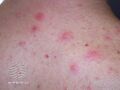 Acne affecting the back images (DermNet NZ acne-acne-back-179).jpg