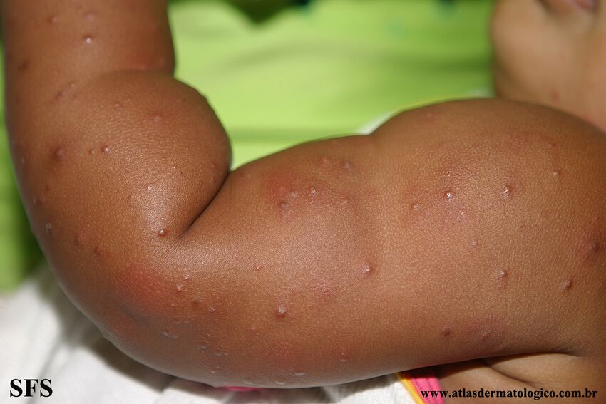Acrodermatitis Infantile Papular (Dermatology Atlas 28).jpg