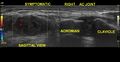 Acromioclavicular joint injury with muscle injuries (ultrasound) (Radiopaedia 80623).jpg