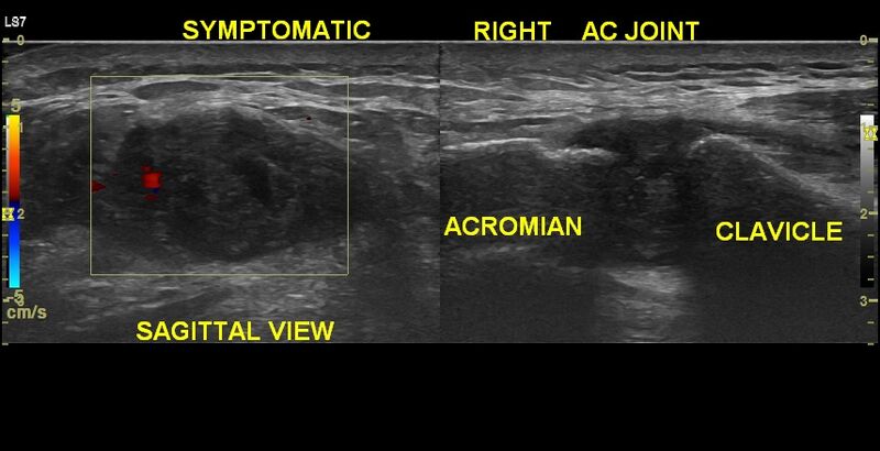 File:Acromioclavicular joint injury with muscle injuries (ultrasound) (Radiopaedia 80623).jpg