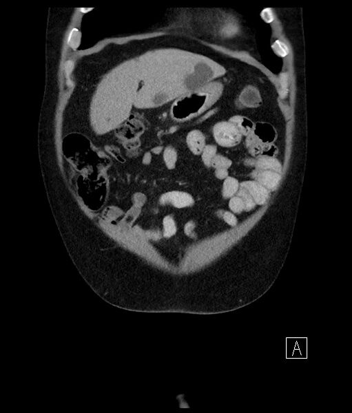 File:Acute-on-chronic pancreatitis (Radiopaedia 67286-76656 Coronal C+ portal venous phase 21).jpg