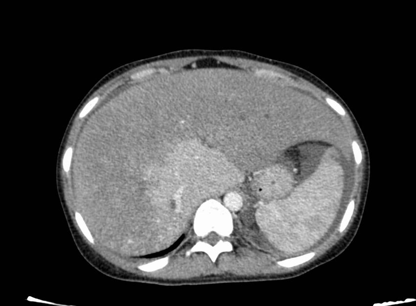 Acute Budd-Chiari syndrome (Radiopaedia 60858-68638 Axial C+ portal venous phase 62).jpg