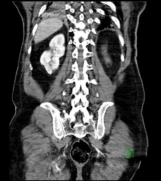 File:Acute arterial mesenteric ischemia (Radiopaedia 78238-90828 Coronal C+ portal venous phase 72).jpg
