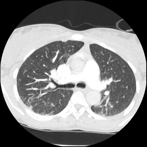File:Acute chest syndrome - sickle cell disease (Radiopaedia 42375-45499 Axial lung window 73).jpg