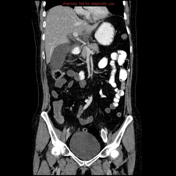 File:Acute gangrenous cholecystitis (Radiopaedia 10123-10661 Coronal C+ portal venous phase 10).jpg