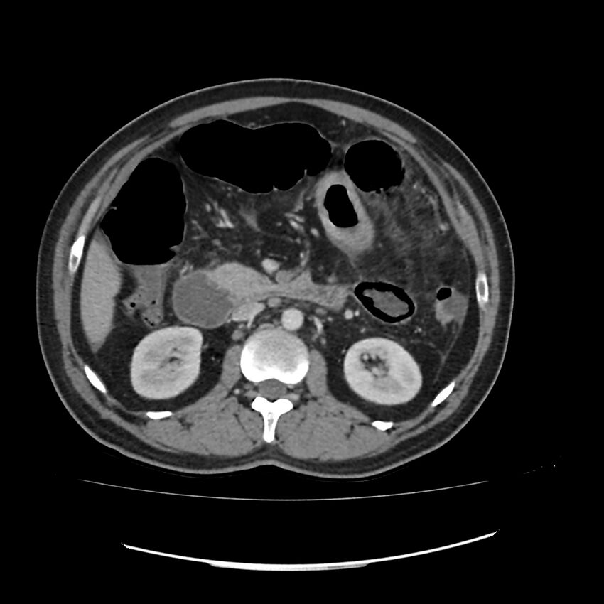Acute mesenteric ischemia - superior mesenteric artery thrombosis (Radiopaedia 73947-84776 Axial C+ portal venous phase 50).jpg
