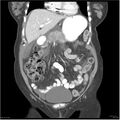 Acute pancreatitis (Radiopaedia 19136-19117 Coronal C+ portal venous phase 11).jpg