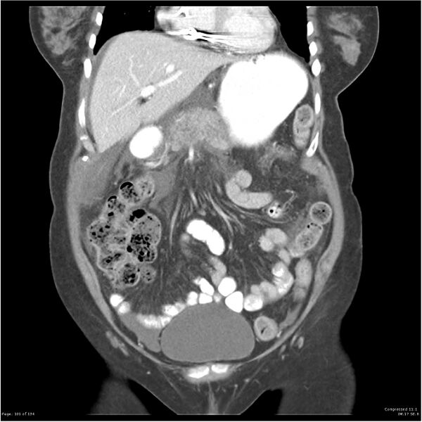 File:Acute pancreatitis (Radiopaedia 19136-19117 Coronal C+ portal venous phase 11).jpg