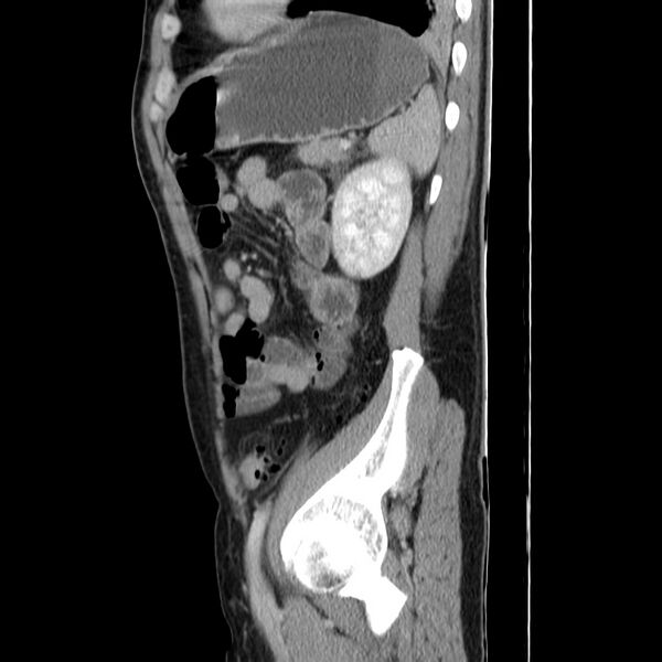 File:Acute pancreatitis (Radiopaedia 22572-22596 Sagittal C+ portal venous phase 41).jpg