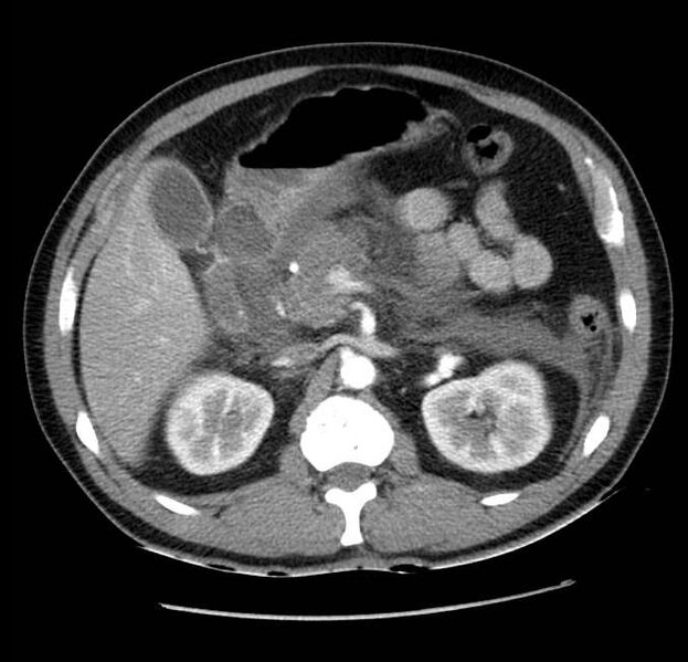 File:Acute pancreatitis - Balthazar E (Radiopaedia 23080-23110 Axial C+ arterial phase 24).jpg