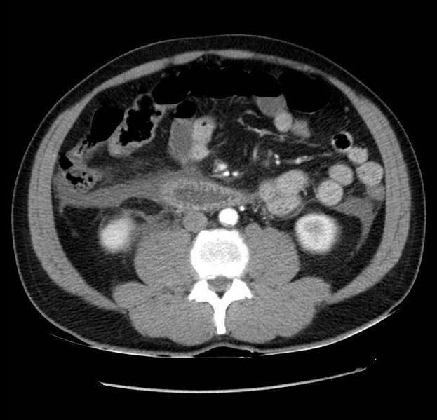 File:Acute pancreatitis - Balthazar E (Radiopaedia 23080-23110 Axial C+ arterial phase 38).jpg