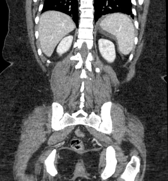 File:Acute pancreatitis - Balthazar E (Radiopaedia 29016-29377 Coronal C+ portal venous phase 70).png