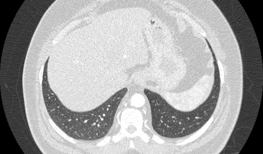 Acute pulmonary embolism with pulmonary infarcts (Radiopaedia 77688-89908 Axial lung window 114).jpg