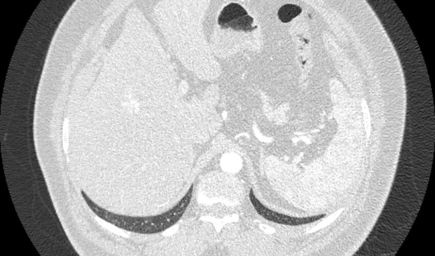 Acute pulmonary embolism with pulmonary infarcts (Radiopaedia 77688-89908 Axial lung window 137).jpg