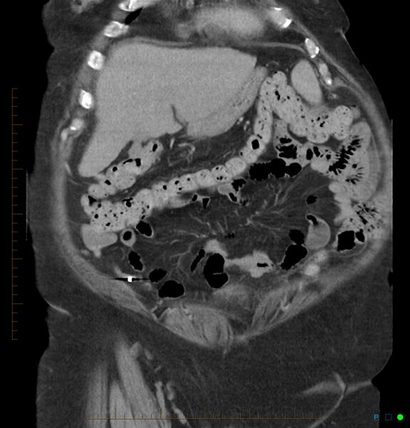 File:Acute renal failure post IV contrast injection- CT findings (Radiopaedia 47815-52559 Coronal C+ portal venous phase 1).jpg