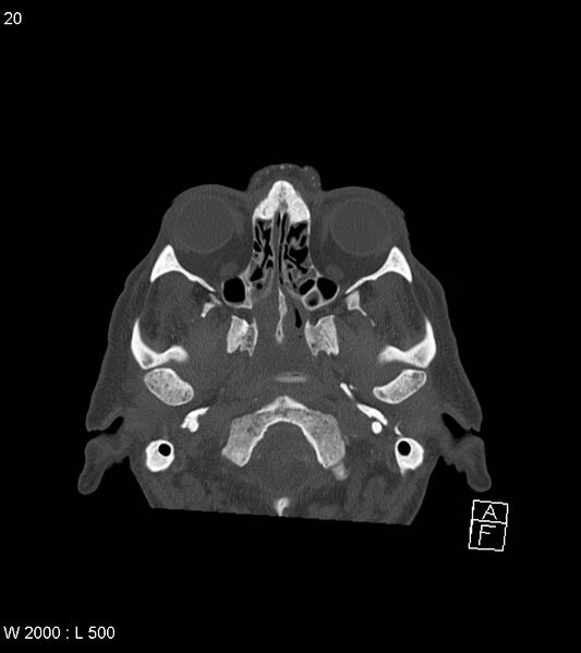 File:Acute subdural hematoma with myelofibrosis (Radiopaedia 52582-58494 Axial bone window 10).jpg