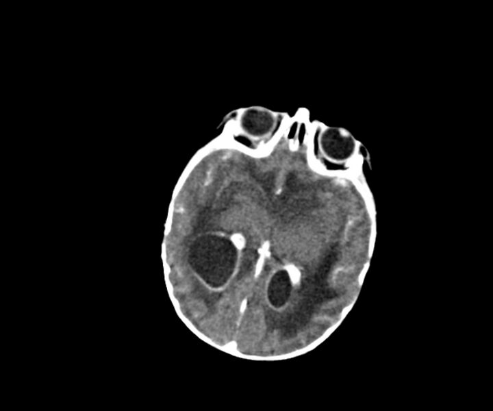 File:Acute ventriculitis (Radiopaedia 57502-64459 Axial +contrast 9).jpg