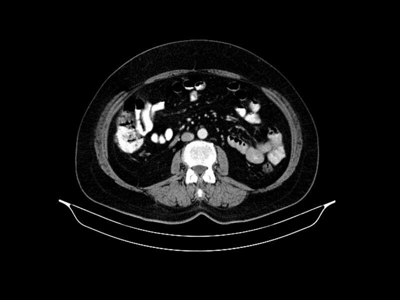 File:Adenocarcinoma of pancreas with hepatic metastasis (Radiopaedia 64332-73122 Axial C+ portal venous phase 54).jpg