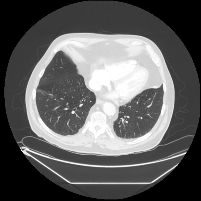 Adenocarcinoma of the lung (Radiopaedia 44876-48759 Axial lung window 59).jpg