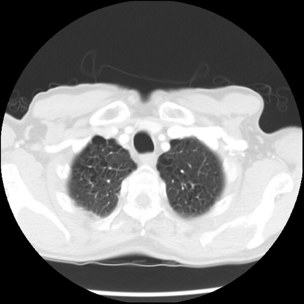 File:Adenocarcinoma of the lung - micropapillary predominant (Radiopaedia 42446-45563 Axial lung window 9).jpg