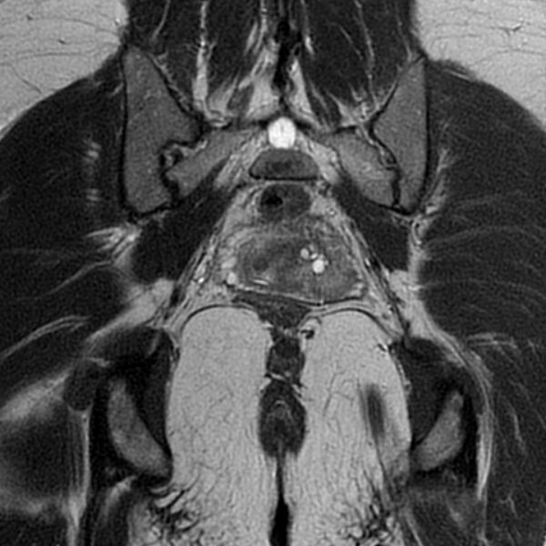 File:Adenomyosis within a septate uterus (Radiopaedia 69963-79981 Coronal T2 28).jpg